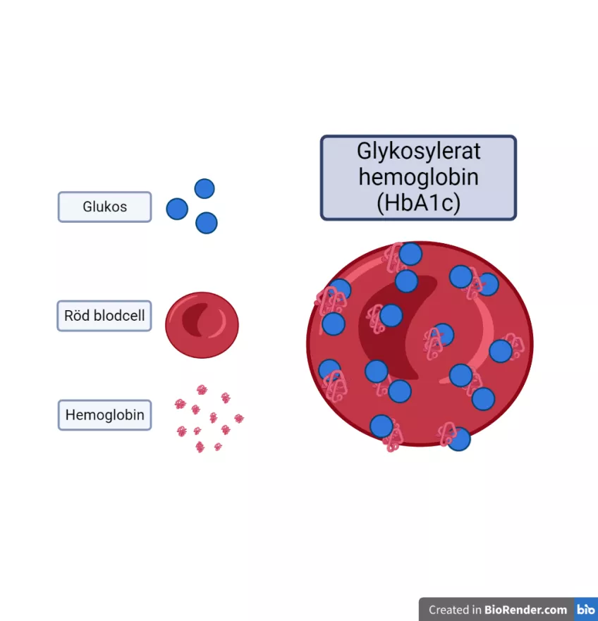 Glykolyserat hemoglobin där glukos bundit in till hemoglobinet i den röda blodcellen. Ritad figur.